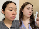 SKISGEM祛痘膏30g淡化痘印消除痘坑修復凝膠青春痘德國進(jìn)口教師節禮物 曬單實(shí)拍圖