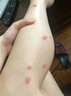 HIEUAILR德國品牌濕疹膏皮膚瘙癢皮炎皮癬真菌感染止癢100%去根專(zhuān)用非藥膏 【濕疹全身癢 反復發(fā)作】?jì)珊醒b 曬單實(shí)拍圖