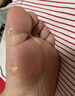 寶芝林香港雞眼貼去根去肉刺刺猴無痛脫落腳底老繭趾疣肉墊刺手腳瘊藥膏 曬單實拍圖