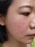 Newliann醫用重組三型人源化膠原蛋白乳液修復敷料凝膠人表皮生長(cháng)因子面霜 曬單實(shí)拍圖