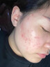 南京同仁堂祛痘膏去痘痘和痘印痘坑修復(fù)男女士改善粉刺閉口30g 曬單實拍圖