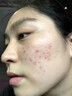 清熱暗瘡丸祛痘痘粉刺痘印醫用痤瘡中藥去青春痘紅腫硬疙瘩痘印消炎膿皰去痘印青少年痤瘡專(zhuān)用藥【視覺(jué)特效】 1盒【醫用祛痘藥】 曬單實(shí)拍圖