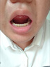 愛牙博士補(bǔ)牙齒神器材料永久自己在家補(bǔ)牙高硬度醫(yī)用進(jìn)口樹脂填充牙洞神器 【加強(qiáng)納米材料】5ML送 工具包 曬單實(shí)拍圖