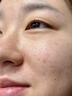醫用精華液械字號收縮毛孔粗大修復細致去黑頭粉刺閉口男士女士祛痘印黑色素沉淀控油淡化痘印痘坑透明質(zhì)酸鈉 曬單實(shí)拍圖