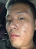 YYTISS祛痘藥膏淡化痘印消除坑炎痤瘡專(zhuān)用青少年去痘痘和痘印青春痘學(xué)生 曬單實(shí)拍圖