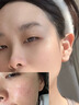 醫用精華液械字號收縮毛孔粗大修復細致去黑頭粉刺閉口男士女士祛痘印黑色素沉淀控油淡化痘印痘坑透明質(zhì)酸鈉 曬單實(shí)拍圖