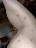 身上皮膚癢秋冬季后背手臂大腿干癢起紅疙瘩長(cháng)小紅點(diǎn)抑菌止癢軟膏 一盒裝 曬單實(shí)拍圖