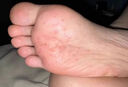 伊人股蘚大腿內(nèi)側(cè)真菌感染腹股溝股癬專用特新效期藥潮濕瘙癢癬藥皮膚瘙癢真菌感染止癢鹽酸特比萘芬噴霧劑 1盒裝【股蘚大腿內(nèi)側(cè)】 曬單實拍圖