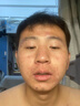 YYTISS祛痘淡化痘印去痘痘和痘印黑色素沉淀痘坑修疤復青春痘祛痘膏學生 曬單實拍圖