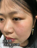 川廿制藥日本 去痣點(diǎn)痣膏醫用專(zhuān)用點(diǎn)疣藥水祛痣膏去黑痣臉部不留疤痣去除 曬單實(shí)拍圖