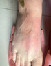 汗皰疹手癢起小水泡濕癢麻疹防手抑脫皮膚陰囊潮濕汗孢疹濕疹止癢抑菌膏手足問(wèn)題男女通用外用瘙癢菌乳膏正品 1盒裝【30g/盒】 曬單實(shí)拍圖