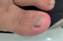 北京同仁堂灰指甲泡腳藥包真菌感染甲床分層增厚損傷指甲壞甲殺菌腳臭足浴包 單盒【體驗裝 30包/盒】 曬單實(shí)拍圖