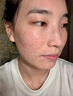 OURHEAL美國祛痘膏去痘痘和痘印坑修復(fù)消炎痤瘡專用凝膠青春痘青少年學(xué)生 曬單實拍圖