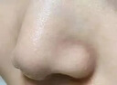 醫(yī)用精華液械字號收縮毛孔粗大修復(fù)細(xì)致去黑頭粉刺閉口男士女士祛痘印黑色素沉淀控油淡化痘印痘坑透明質(zhì)酸鈉 曬單實拍圖