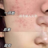 透真控油祛痘水乳套裝茶樹油修復(fù)痘印收縮毛孔補水爽膚水青少年護膚品 曬單實拍圖