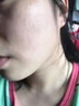 清熱暗瘡丸祛痘痘粉刺痘印醫用痤瘡中藥去青春痘紅腫硬疙瘩痘印消炎膿皰去痘印青少年痤瘡專(zhuān)用藥【視覺(jué)特效】 1盒【醫用祛痘藥】 曬單實(shí)拍圖