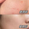 維特絲（vetes）去角質(zhì)面部啫喱控油保濕洗面奶男女士清潔毛孔黑頭閉口溫沒激素和 【6大專利】果酸去角質(zhì)啫喱200g 曬單實(shí)拍圖