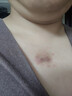 芭博士美國ScarMD輔助改善疤痕膏醫用剖腹產(chǎn)手術(shù)后增生疤痕進(jìn)口硅凝膠 15克適用大疤痕7-12厘米可用2-3個(gè)月 發(fā)順豐 曬單實(shí)拍圖