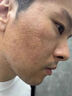 廣雅祛痘坑痘印淡化消除修復(fù)膏男女士臉部凹洞填充再生長因子凝膠 一盒【專業(yè)去痘坑】 曬單實(shí)拍圖