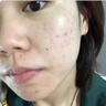 同仁堂（TRT）祛痘膏去痘痘和痘印痘坑初高中生男女學(xué)生粉刺青春痘淡化痘印20g 曬單實(shí)拍圖