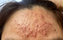 醫用痤瘡中藥去青春痘粉刺紅腫硬疙瘩痘印祛痘痘消炎痤瘡膿皰瘡去痘印青少年專(zhuān)用清熱暗瘡丸【視覺(jué)特效】 3盒【療程裝】 曬單實(shí)拍圖
