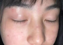 協(xié)南藥業(yè)去痣點痣膏祛痣點痣點疣藥水點痣醫(yī)用專用官方正品黑痣臉部不留疤 曬單實拍圖