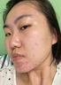 維特絲壬二酸祛痘藥膏煙酰胺凝膠去痘痘粉刺閉口男女水楊酸收毛孔青少年 曬單實(shí)拍圖