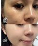 OHBT祛痘膏60g青春痘閉孔粉刺收縮毛孔專用學(xué)生男女凝膠男士化妝品 曬單實(shí)拍圖