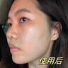 Newliann醫用祛痘貼去痘痘和痘印消炎吸膿隱形修復膏淡化痘坑痤瘡專(zhuān)用制藥 曬單實(shí)拍圖