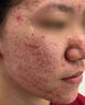 DR.AVIN【德國品牌】醫(yī)用痘坑修復凹洞填充再生長因子祛痘印淡化修復男BD 送醫(yī)用棉簽【買二送一】療程裝大部分用戶選擇 曬單實拍圖