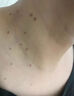 維A酸乳膏去疣醫(yī)用去疣膏瘊靈去除脖子小肉粒扁平疣專用藥脖子頸部疣體脫落皮膚用藥 非處方藥【視覺特效】 2盒裝[脖子小肉粒不美觀] 曬單實(shí)拍圖