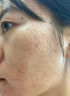 DR.AVIN【德國品牌】醫(yī)用痘坑修復(fù)凹洞填充再生長因子祛痘印淡化修復(fù)男BD 送醫(yī)用棉簽【買二送一】療程裝大部分用戶選擇 曬單實(shí)拍圖