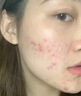 OHBT祛痘膏60g青春痘閉孔粉刺收縮毛孔專(zhuān)用學(xué)生男女凝膠男士化妝品 曬單實(shí)拍圖