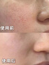 醫(yī)用精華液械字號(hào)收縮毛孔粗大修復(fù)細(xì)致去黑頭粉刺閉口男士女士祛痘印黑色素沉淀控油淡化痘印痘坑透明質(zhì)酸鈉 曬單實(shí)拍圖