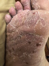 川廿制藥日本狼毒腳氣噴霧劑克星軟膏止癢脫皮爛腳丫真菌感染治腳氣腳臭 曬單實(shí)拍圖