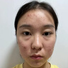 維特絲壬二酸祛痘藥膏煙酰胺凝膠去痘痘粉刺閉口男女水楊酸收毛孔青少年 曬單實(shí)拍圖