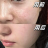 醫(yī)用精華液械字號(hào)收縮毛孔粗大修復(fù)細(xì)致去黑頭粉刺閉口男士女士祛痘印黑色素沉淀控油淡化痘印痘坑透明質(zhì)酸鈉 曬單實(shí)拍圖