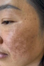 焦博士日本377祛斑霜美白淡化老年黃褐雀斑黑色素熊果苷乳膏去曬男女士 曬單實拍圖