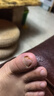 楚甲 鹽酸阿莫羅芬搽劑 1.5ml 國藥準(zhǔn)字治療灰指甲專用藥灰指甲正品真菌感染皮膚用藥抑菌液阿莫羅芬搽劑正品旗艦店 曬單實拍圖