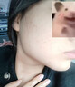 維特絲壬二酸祛痘膏煙酰胺凝膠去痘痘和痘印粉刺閉口水楊酸收毛孔青少年 曬單實(shí)拍圖