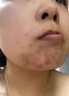 阿達(dá)帕林凝膠醫(yī)用祛痘消炎痤瘡專用青少年藥膏去痘痘和痘印閉合性粉刺藥膏臉上長痘痘治療重度青春痘硬疙瘩 1盒裝【粉刺膿包痘印】 曬單實(shí)拍圖
