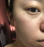 久卜制藥醫用痘痘貼消炎吸膿隱形輕薄祛痘人工皮修復淡化遮瑕貼108貼/盒 曬單實(shí)拍圖