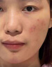 維特絲壬二酸祛痘藥膏煙酰胺凝膠去痘痘粉刺閉口男女水楊酸收毛孔青少年 曬單實(shí)拍圖