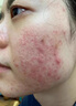 OHBT祛痘膏60g青春痘閉孔粉刺收縮毛孔專用學(xué)生男女凝膠男士化妝品 曬單實拍圖