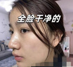 歐泉琳家用美容院專(zhuān)用激光去疣祛斑儀器黑痣疣子去除神器 升級款【點(diǎn)痣不傷膚 穩定無(wú)痛】 贈價(jià)值139元禮包 曬單實(shí)拍圖