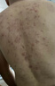 北京同仁堂后背痘痘藥膏后背長(zhǎng)痘痘毛囊炎專用前胸后背部膿包痤瘡祛痘噴霧劑 買2送1【發(fā)3盒】發(fā)貨特效快 曬單實(shí)拍圖