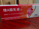 維A酸乳膏 脂肪粒去除眼部專(zhuān)用藥育 汗管瘤去除膏 用于眼周白色顆粒油脂粒黑眼圈去藥除無(wú)痛專(zhuān)用藥膏 1盒裝【幾粒脂肪?！?曬單實(shí)拍圖