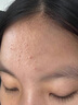 透真控油祛痘水乳套裝茶樹(shù)油修復痘印收縮毛孔補水爽膚水青少年護膚品 曬單實(shí)拍圖