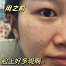 焦博士日本377祛斑霜美白淡化老年黃褐雀斑黑色素熊果苷乳膏去曬男女士 曬單實(shí)拍圖