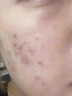 維特絲愈創(chuàng  )木祛痘控油修護保濕乳液淡化痘印去痘痘收縮毛孔男女士護膚品 曬單實(shí)拍圖